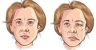 La cirugía permite mejorar la calidad de vida y la autoestima de los pacientes con parálisis facial