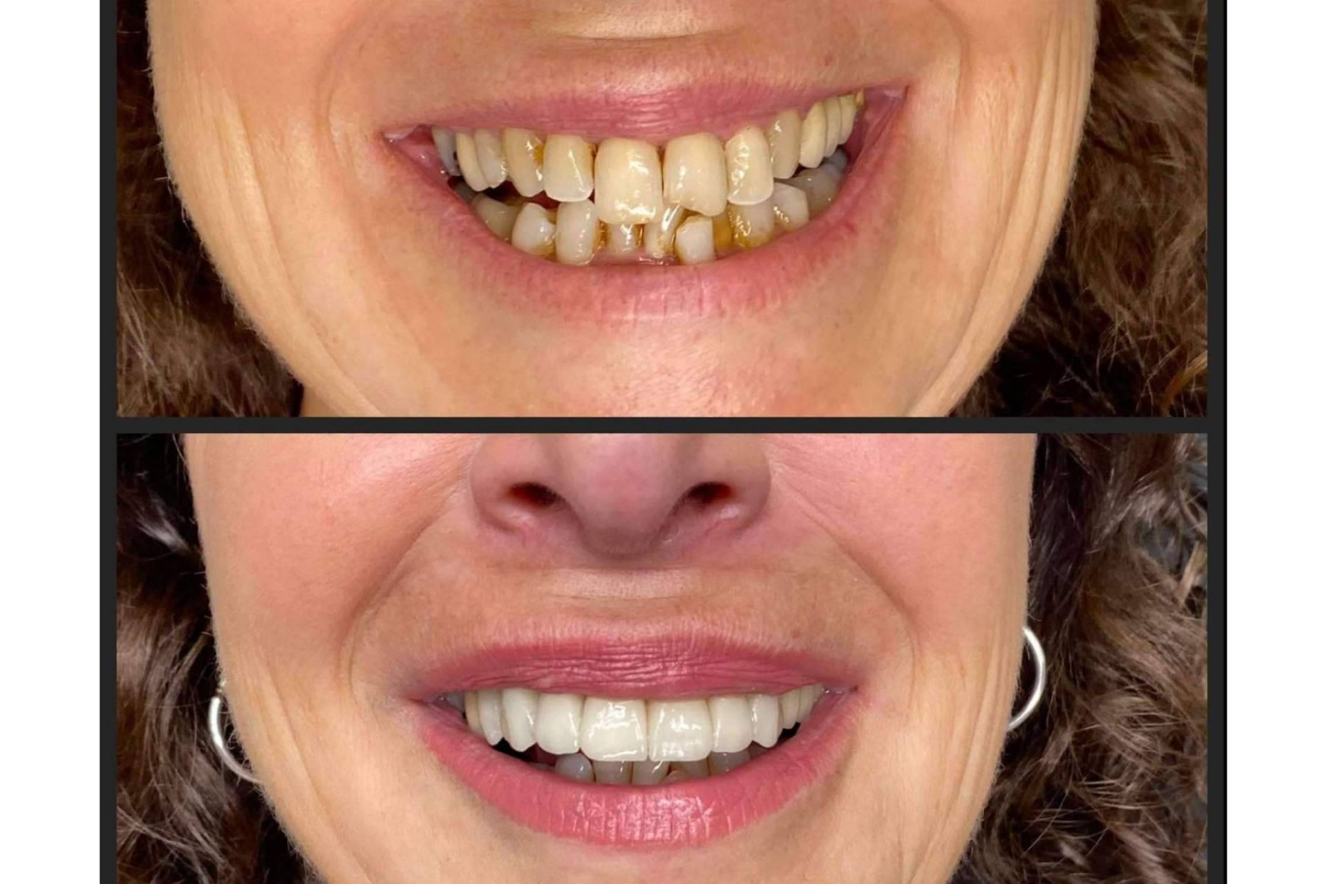 Prevenir el sangrado de encías, con ayuda de Dentinova