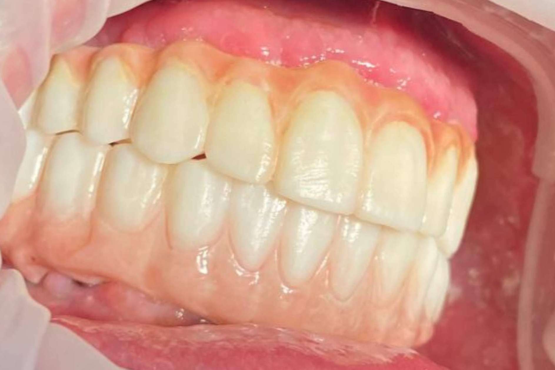 La impresión 3D devuelve los dientes en un día, con Dentinova