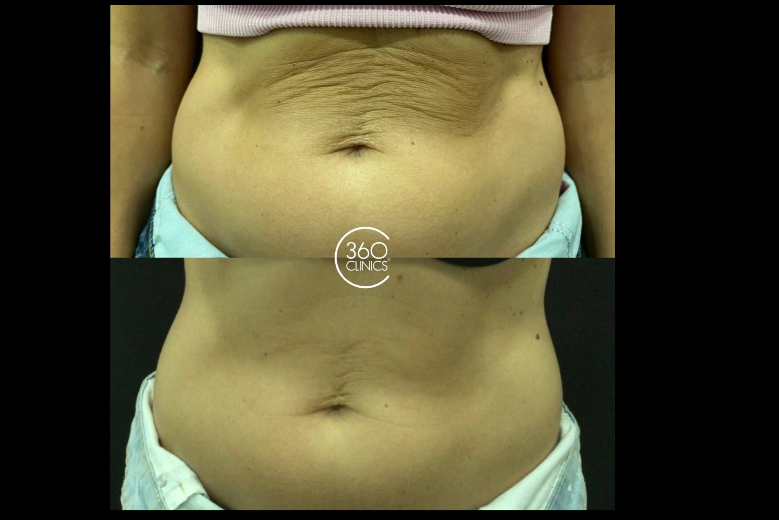 Philart corporal, el innovador tratamiento para eliminar la flacidez y celulitis, disponible en 360 Clinics