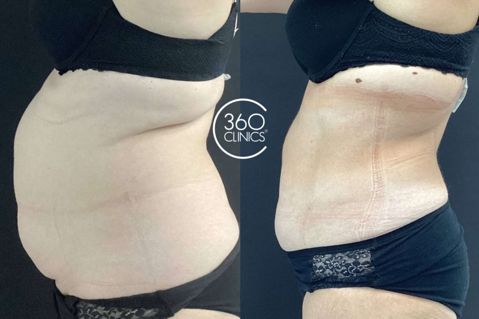 360Clinics lidera con Lipo Láserfit Medical, la revolución en tratamientos corporales sin cirugía