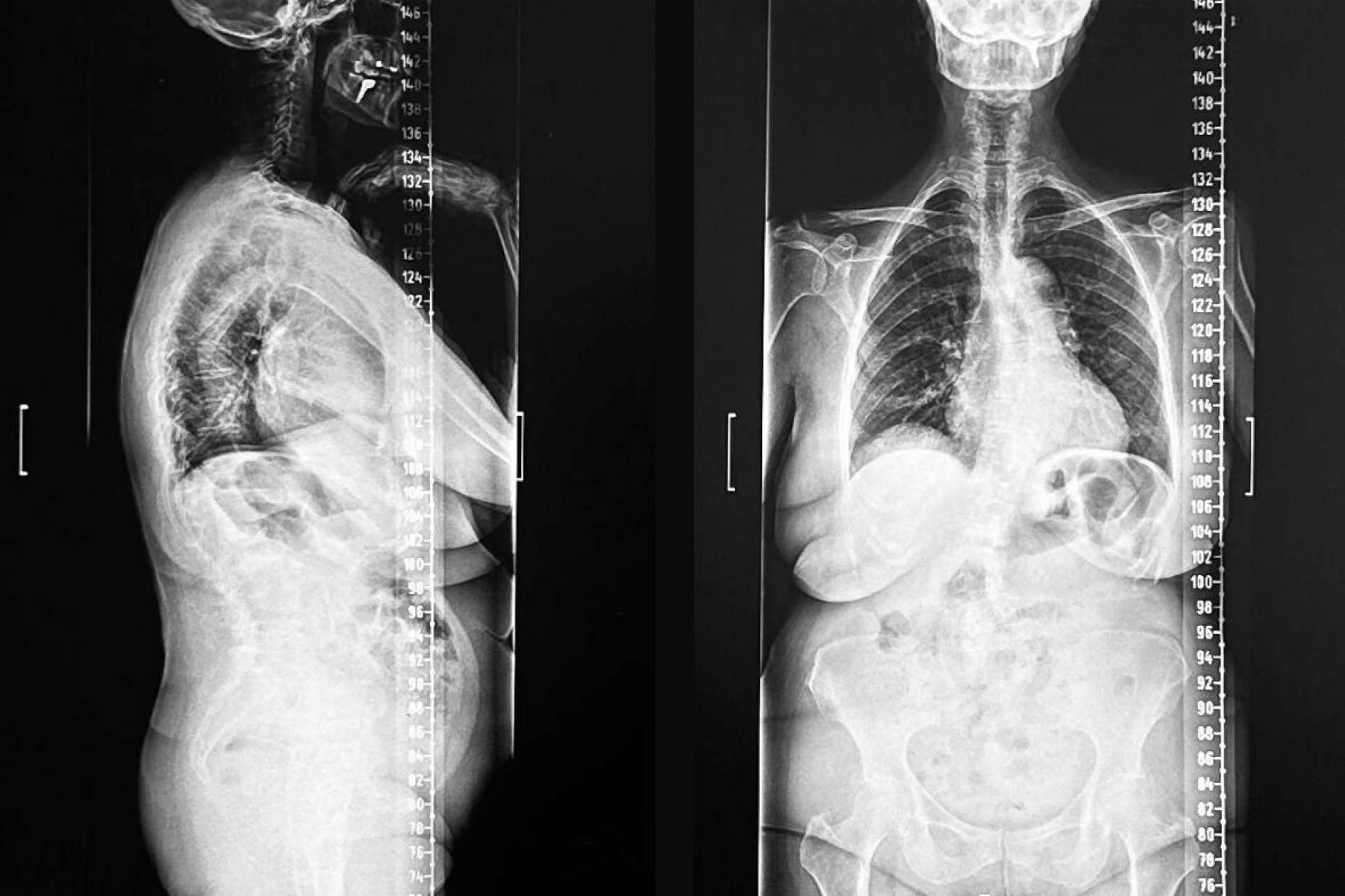 Escoliosis lumbar del adulto y tratamiento quirúrgico con guías 3D