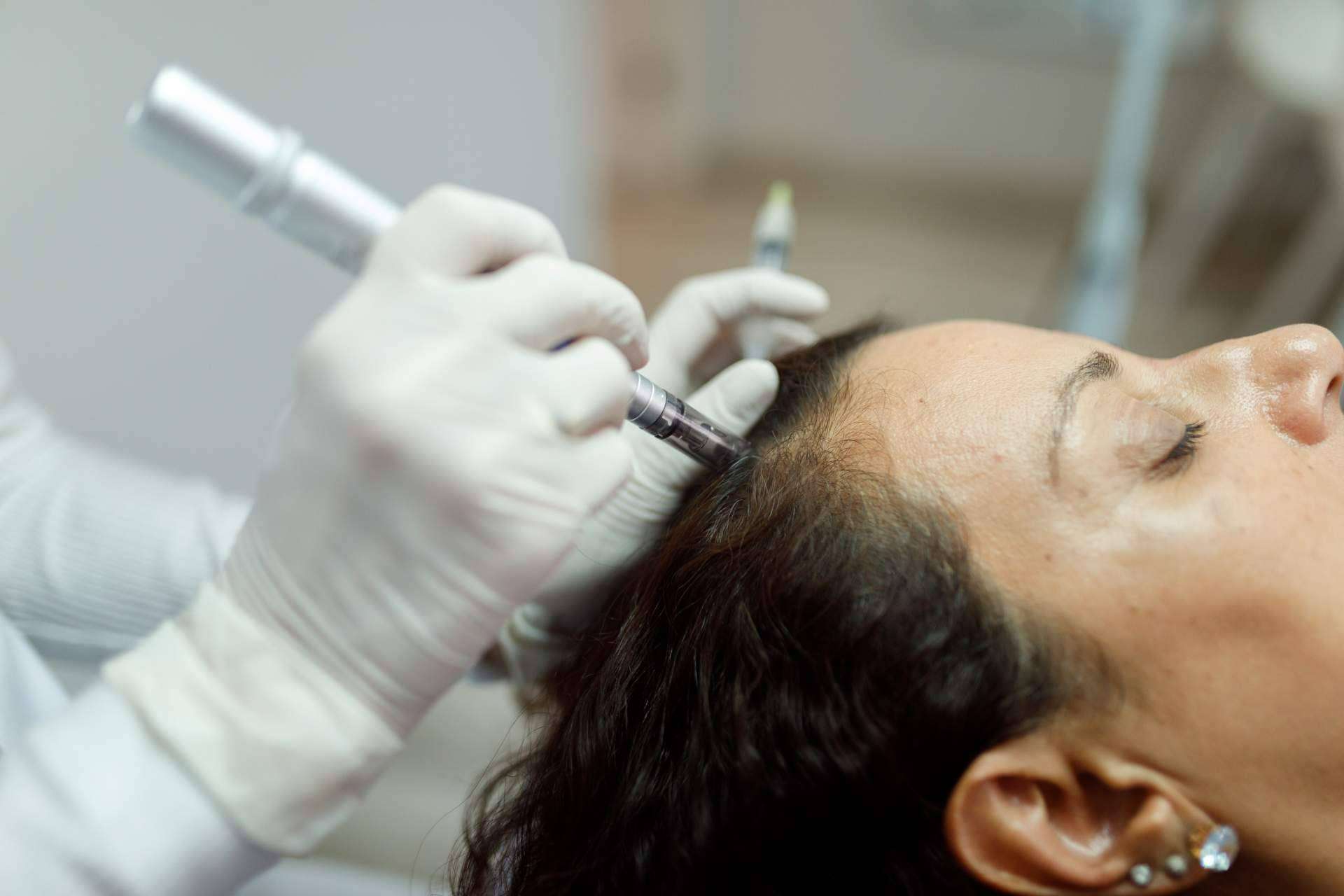 Clínica Capilar IMD llega a Valladolid, soluciones capilares para todo tipo de alopecia