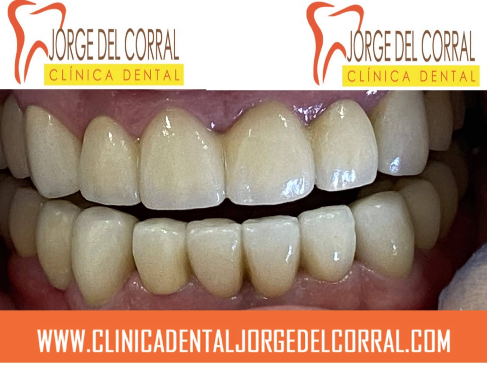 La Clínica Dental Jorge del Corral en Hortaleza, Madrid, ofrece implantes dentales con descuento y primera consulta gratuita