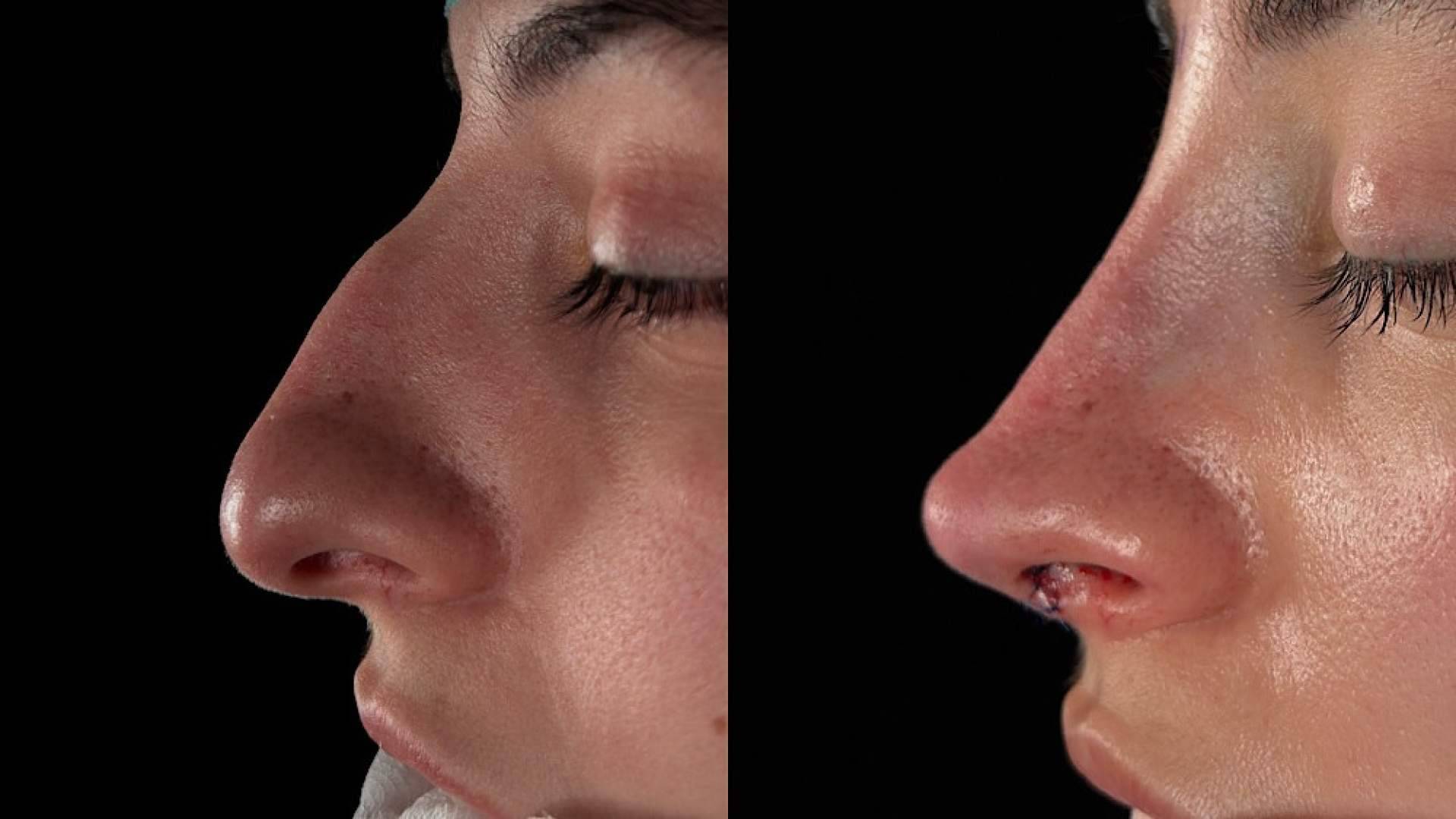 Rinoplastia y percepción personal, el miedo a dejar de reconocerse