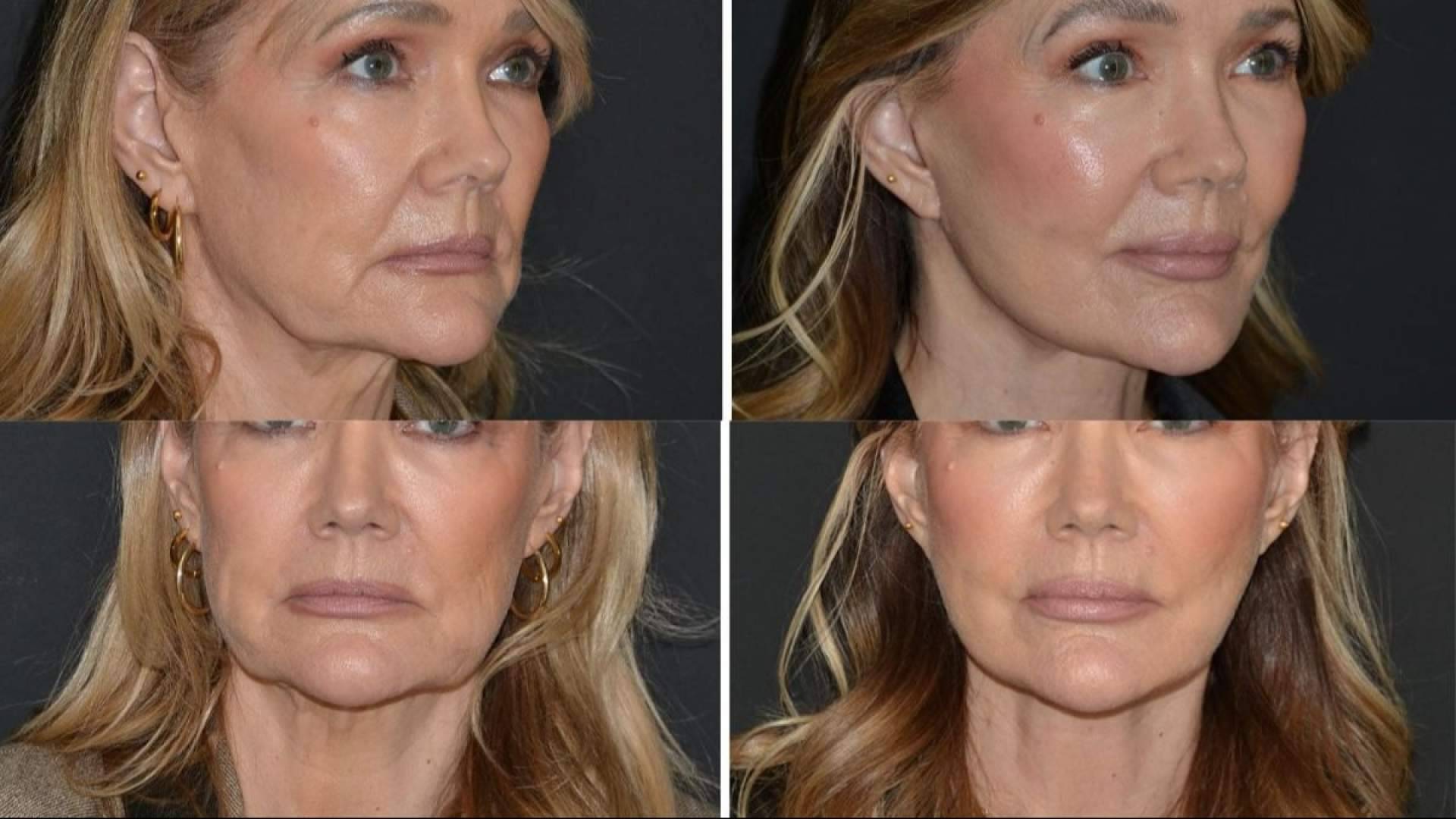 Cómo el Deep Plane Facelift está cambiando las reglas del rejuvenecimiento facial en 2026